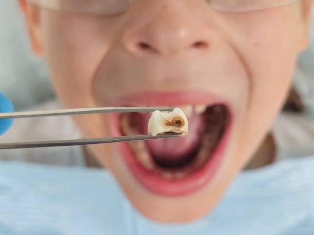 Best Emergency Broken Tooth Repair in Springboro, OH