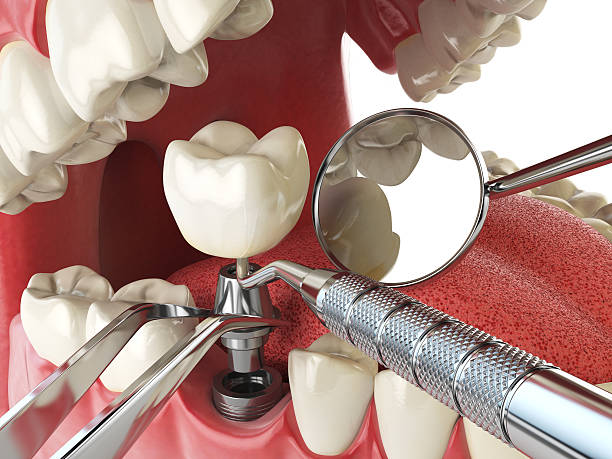 Best Emergency Tooth Extraction in Springboro, OH